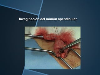 Invaginación del muñón apendicular
 