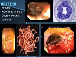 ETIOLOGIA
Fecalito
Hipertrofia linfoide
Cuerpo extraño
Tumoral
 