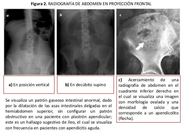 Apendicitis Aguda En Radiologia