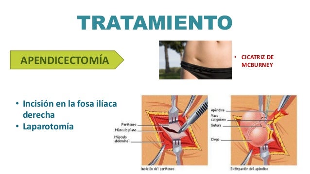 diabetes insípida fisiopatología central de la apéndice