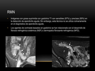 RMN
• Imágenes con grasa suprimida con gadolinio T1 son sensibles (97%) y precisas (95%) en
la detección de apendicitis aguda; Sin embargo, esta técnica no se utiliza rutinariamente
en el diagnóstico de apendicitis aguda.
• Los agentes de contraste basados en gadolinio se han relacionado con el desarrollo de
fibrosis nefrogénica sistémica (NSF) o dermopatía fibrosante nefrogénica (NFD).
 