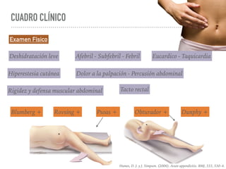 Apendicitis aguda | PDF