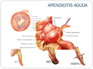 APENDICITIS AGUDA
 
