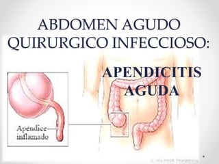 ABDOMEN AGUDO
QUIRURGICO INFECCIOSO:
APENDICITIS
AGUDA
 