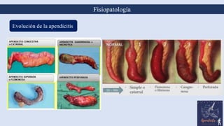 10
Fisiopatología
Evolución de la apendicitis
 