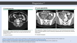 Diagnóstico1,3
17
1. Martin R. Acute appendicitis in adults: Clinical manifestations and differential diagnosis [Internet]. Up to date; 2018 [cited 28 September 2019]. Available from:
https://www.uptodate.com/contents/acute-appendicitis-in-adults-clinical-manifestations-and-differential-diagnosis
3. Martin R, Kang S. Acute appendicitis in adults: Diagnostic evaluation [Internet]. Up to date; 2018 [cited 28 September 2019]. Available from:
https://www.uptodate.com/contents/acute-appendicitis-in-adults-diagnostic-evaluation
 