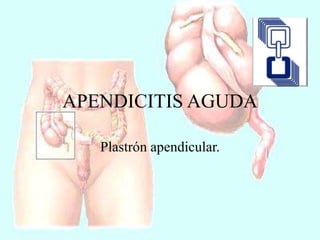 APENDICITIS AGUDA
Plastrón apendicular.
 