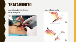 TRATAMIENTO
Apendicectomía abierta Apendicectomía
laparoscópica
 