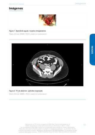 Apendicitis aguda Imágenes
Imágenes
Figura 1: Apendicitis aguda: muestra intraoperatoria.
Nasim Ahmed, MBBS, FACS; usado con autorización
Figura 2: TC de abdomen: apéndice engrosado.
Nasim Ahmed, MBBS, FACS; usado con autorización
IMAGES
Esta versión en PDF de la monografía de BMJ Best Practice está basada en la
versión disponible en el sitio web actualizada por última vez en: May 01, 2020.
Las monografías de BMJ Best Practice son actualizadas regularmente y la versión más reciente
disponible para cada monografía puede consultarse en bestpractice.bmj.com . La utilización de este
contenido está sujeta a nuestra declaración de exoneración de responsabilidad (. La utilización de este
contenido está sujeta a nuestra ) . © BMJ Publishing Group Ltd 2020. Todos los derechos reservados.
43
 