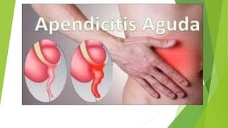 Apendicitis aguda
 