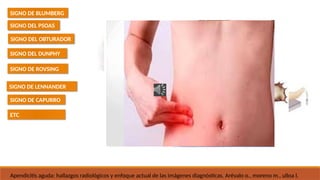 APENDICITIS AGUDA.para salud y medicinapptx | PPTX