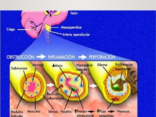 Comprehensive Overview of Acute Appendicitis: Anatomy, Epidemiology ...