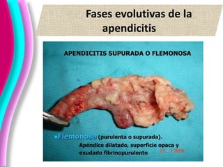 Fases evolutivas de la
apendicitis
 