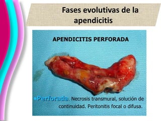 Fases evolutivas de la
apendicitis
 