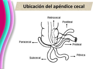 Ubicación del apéndice cecal
 