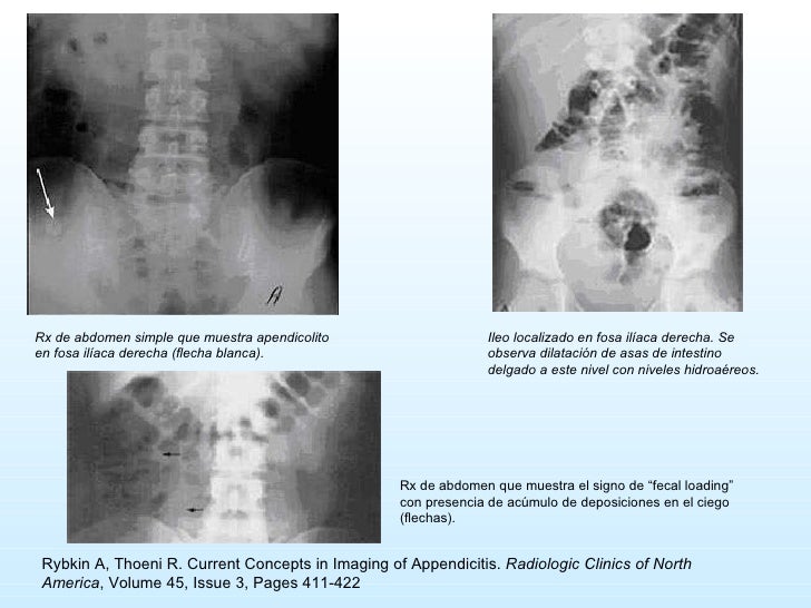 Apendicitis Aguda 0809