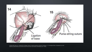 Zollinger RM, Ellison EC, Zollinger RM. Zollinger’s atlas of surgical operations: Robert M. Zollinger Jr., E. Christopher Ellison ; illustrations for ninth
editions by Marita Bitans and Jennifer Smith. 9th ed. New York: McGraw-Hill Medical; 2011. 506 p.
 