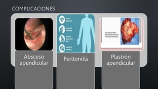 Absceso
apendicular
Peritonitis Plastrón
apendicular
 