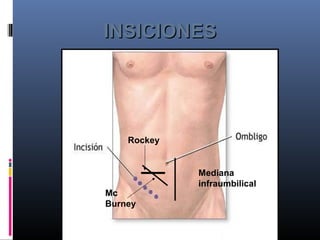INSICIONESINSICIONES
Mediana
infraumbilical
Mc
Burney
Rockey
 