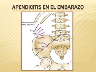 APENDICITIS EN EL EMBARAZO
 