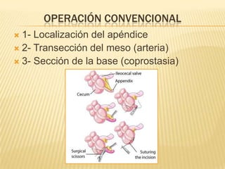 OPERACIÓN CONVENCIONAL
 1- Localización del apéndice
 2- Transección del meso (arteria)
 3- Sección de la base (coprostasia)
 