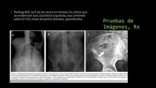 Pruebas de
Imágenes, Rx
• Radiografía: 50% de las veces es normal, los datos que
se evidencian son, Escoliosis izquierda, asa centinela
sobre la FID, masa de partes blandas, apendicolito
 