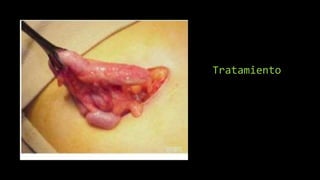 Tratamiento
 