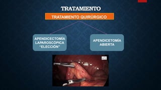 TRATAMIENTO
TRATAMIENTO QUIRÚRGICO
APENDICETOMÍA
ABIERTA
APENDICECTOMÍA
LAPAROSCÓPICA
“ELECCIÓN”
 