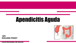 Apendicitis Aguda
INT:
GUILIANA POGGY
CAJA NACIONAL DE SALUD
 