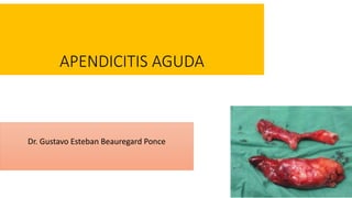 APENDICITIS AGUDA
Dr. Gustavo Esteban Beauregard Ponce
APENDICITIS AGUDA
 