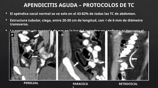 APENDICITIS AGUDA Y MUCOCELE APENDICULAR pptx APENDICITIS AGUDA Y MUCOCELE APENDICULAR pptx
