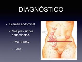 DIAGNÓSTICO
• Examen abdominal.
• Múltiples signos
abdominales.
• Mc Burney.
• Lanz.
 