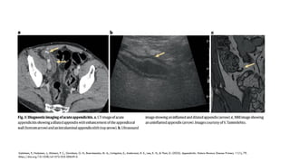 Appendix Nature Comprehensive Overview of Appendicitis: Pathophysiology, Diagnosis, and ...