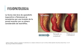 Comprehensive Overview of Appendicitis: Pathophysiology, Diagnosis, and ...