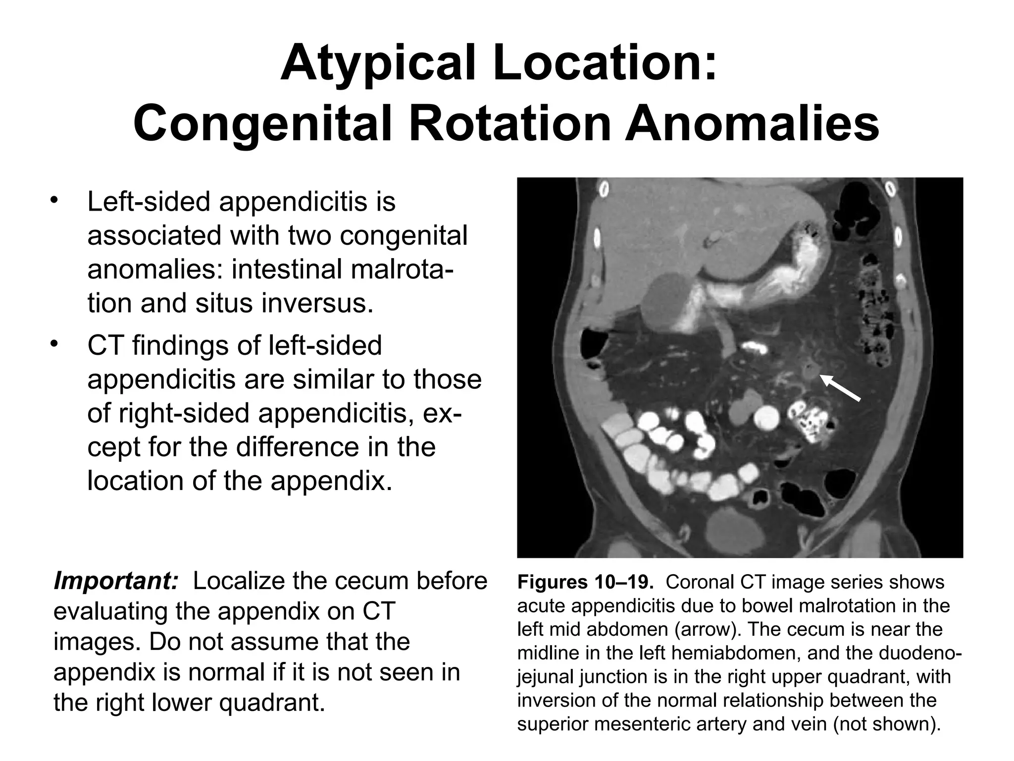 Apendicitis CT atypical Radiologia e Imagen | PPTX
