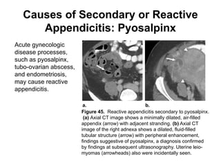 Apendicitis CT atypical Radiologia e Imagen | PPTX