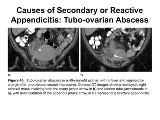 Apendicitis CT atypical Radiologia e Imagen | PPTX