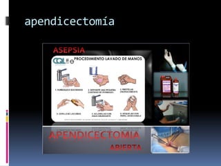 apendicectomía
 