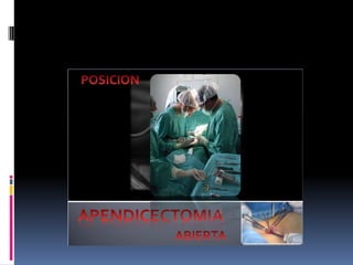 Apendicitis dr acuña