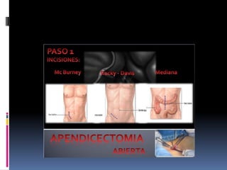 Apendicitis dr acuña