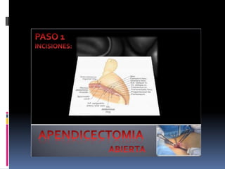 Apendicitis dr acuña