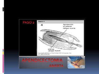 Apendicitis dr acuña