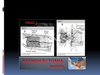 Apendicitis dr acuña