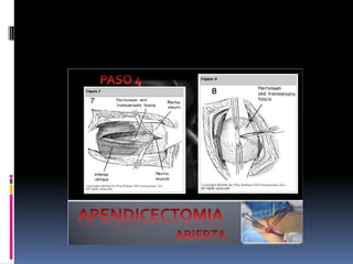 Apendicitis dr acuña