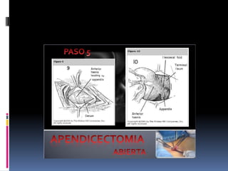 Apendicitis dr acuña