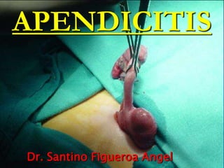 Dr. Santino Figueroa Angel
APENDICITIS
 