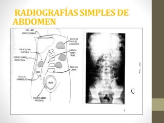 RADIOGRAFÍAS SIMPLES DE
ABDOMEN
 