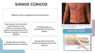 APENDICITIS AGUDA PRESENTACION FINAL PPTX | PPTX