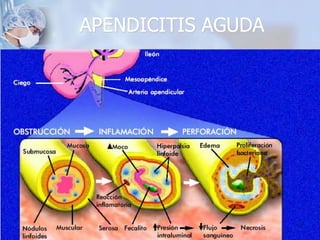 APENDICITIS AGUDA
24
 