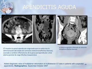 CT muestra la pared apendicular engrosada que se realza tras la
administración del medio de contraste endovenoso(flechas b...